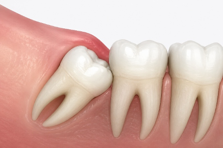 cirugia-dientes-retenidos-02